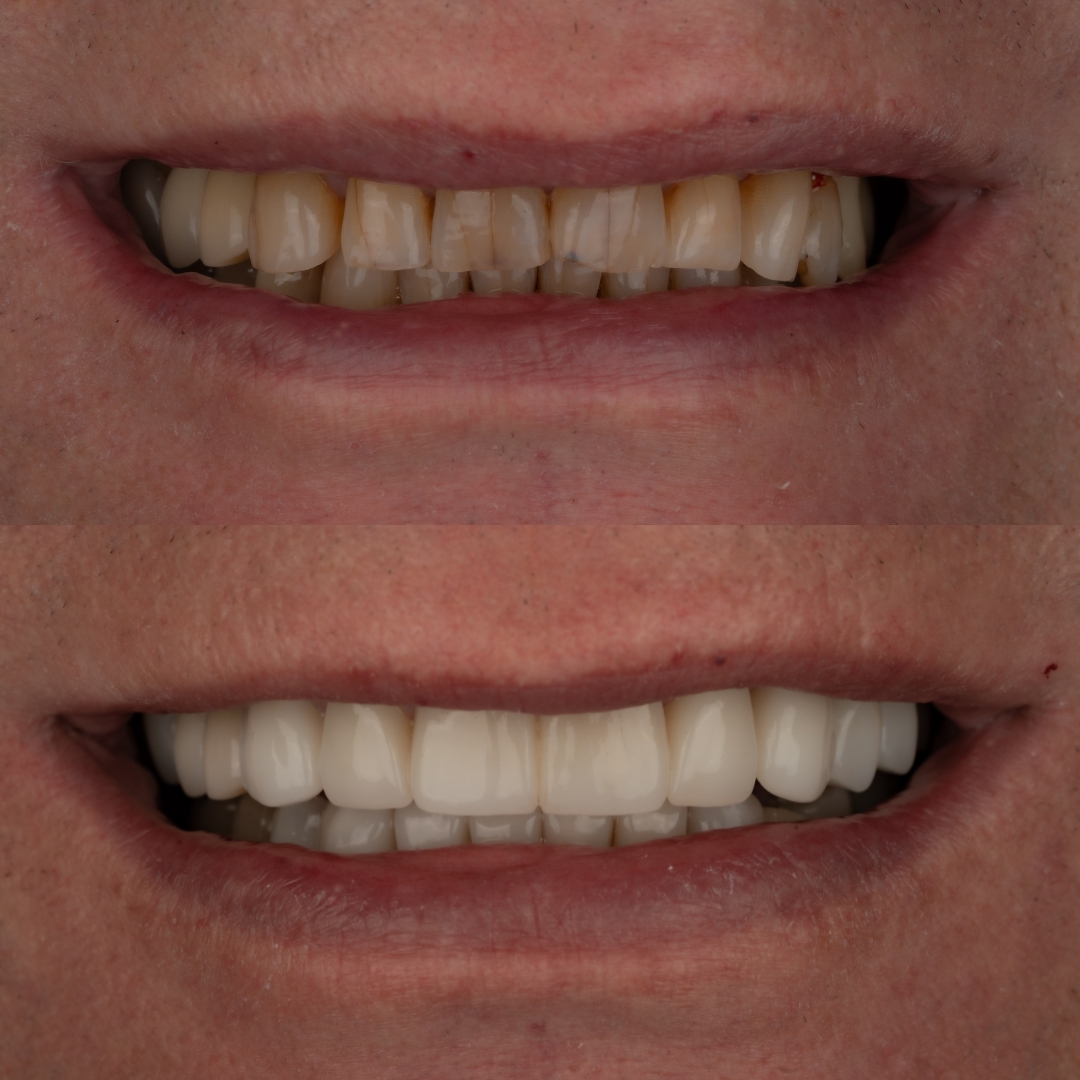 Before and after porcelain crowns for a natural smile